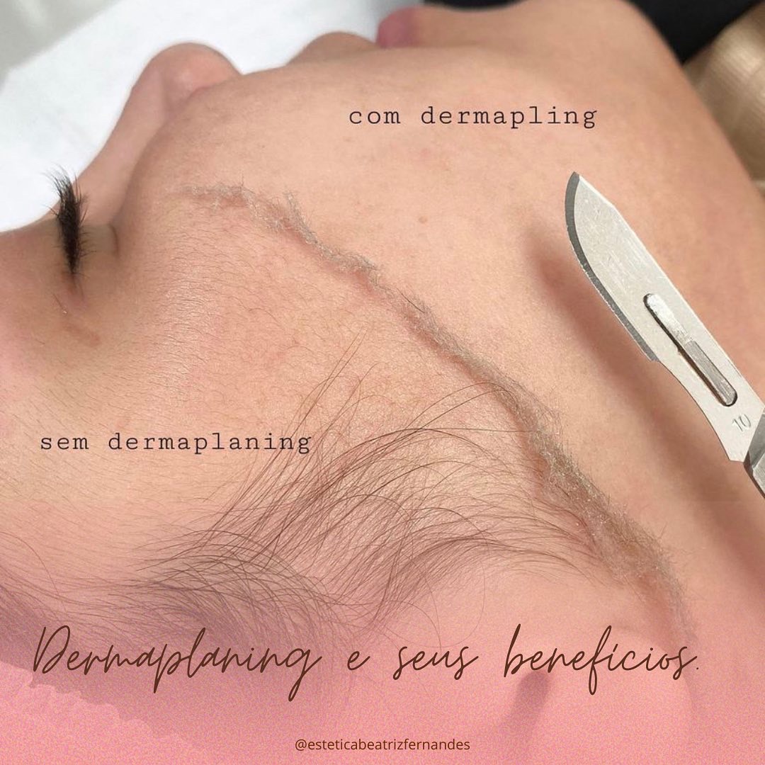 Dermaplaning