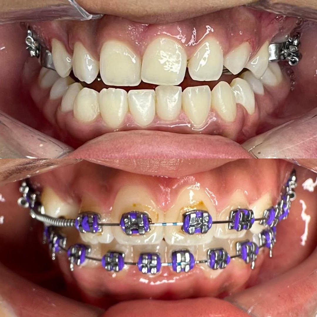 Aparelho ortodôntico colorido nos dentes