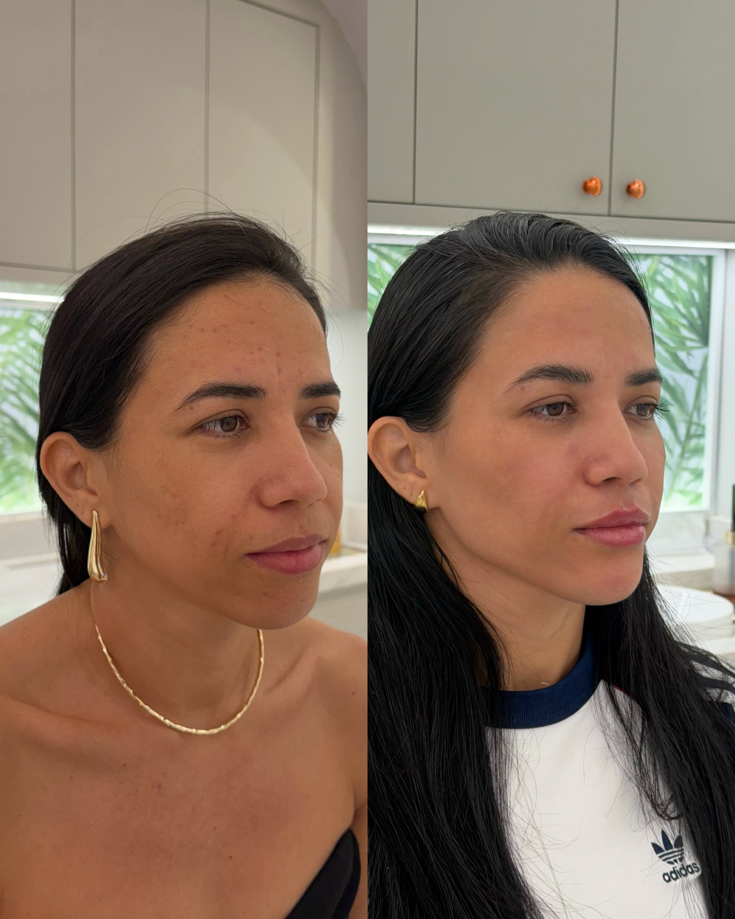 Antes e depois de harmonização facial, resultado natural