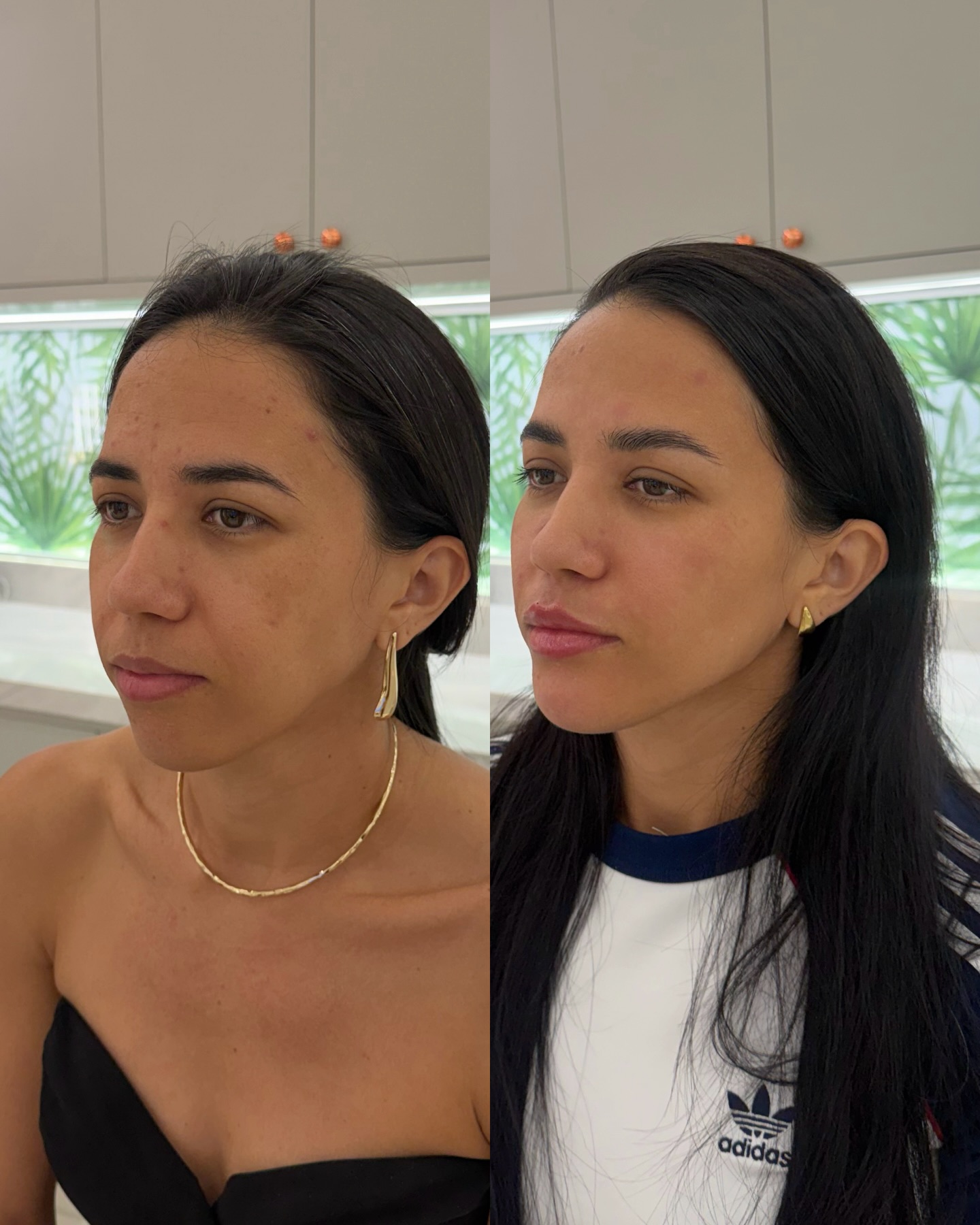 Antes e depois de harmonização facial, resultado natural
