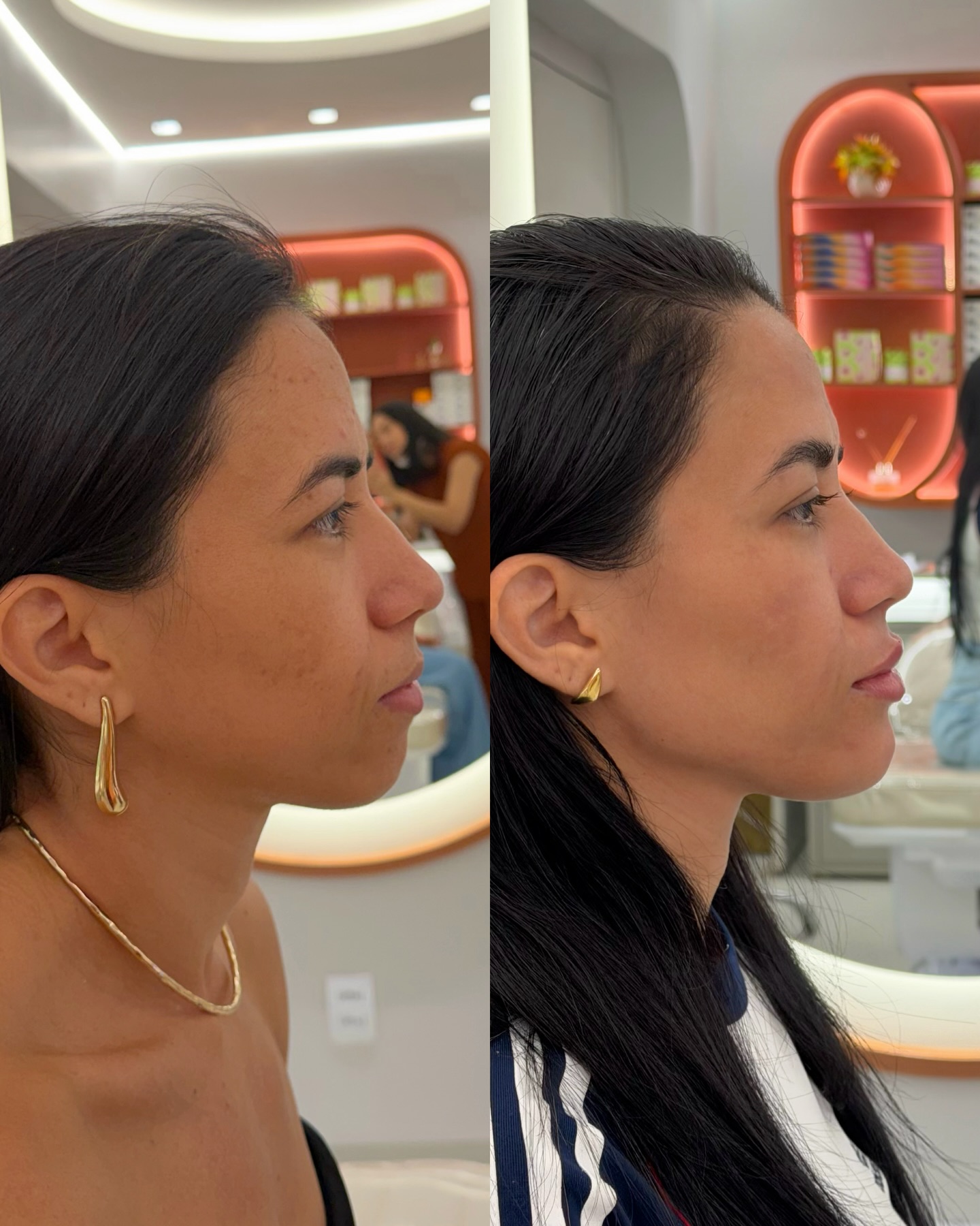Antes e depois de harmonização facial, perfil
