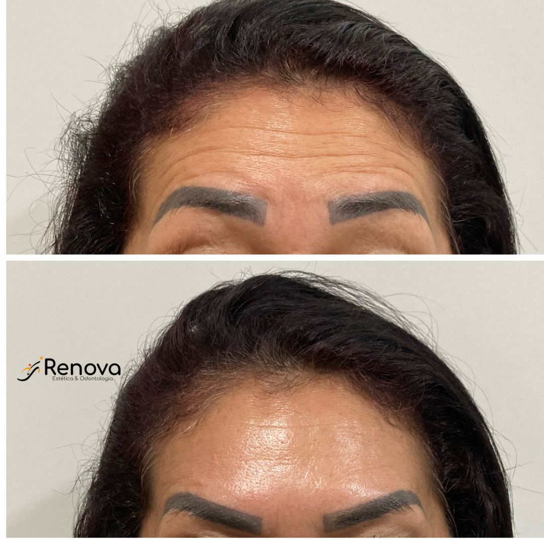 Antes e depois de tratamento facial