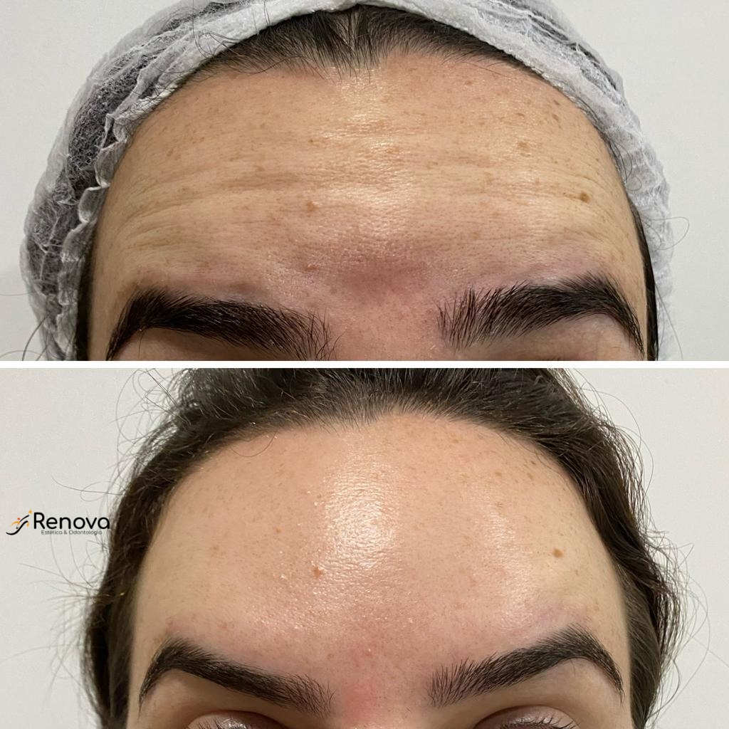 Antes e depois de tratamento facial